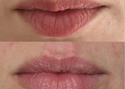 pre e post trattamento filler natural lip