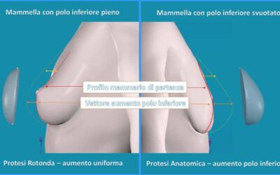 Quali protesi sono migliori per un risultato naturale? Anatomiche o Rotonde?