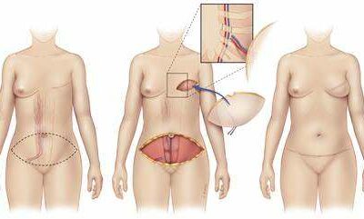 Ricostruzione Mammaria Autologa – DIEP – in Calabria