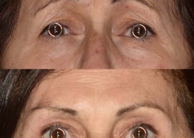 belfaroplastica superiore con lifting del sopracciglio