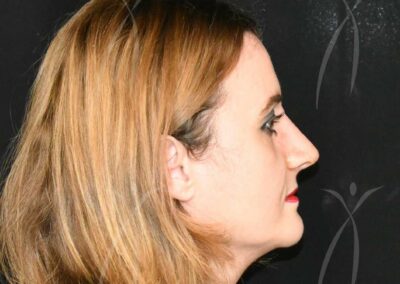 preservation rhinoplasty in calabria