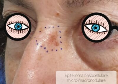 rimozione epitelioma basocellulare
