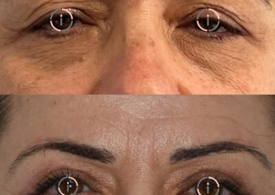 rimozione cicatrice palpebra superiore e blefaroplastica