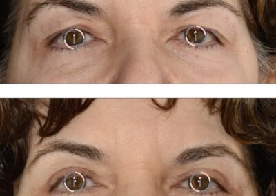 dermatoaclasi superiore blefaropalstica superiore