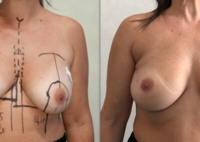 ricostrizione mammaria immediata con protesi in silicone
