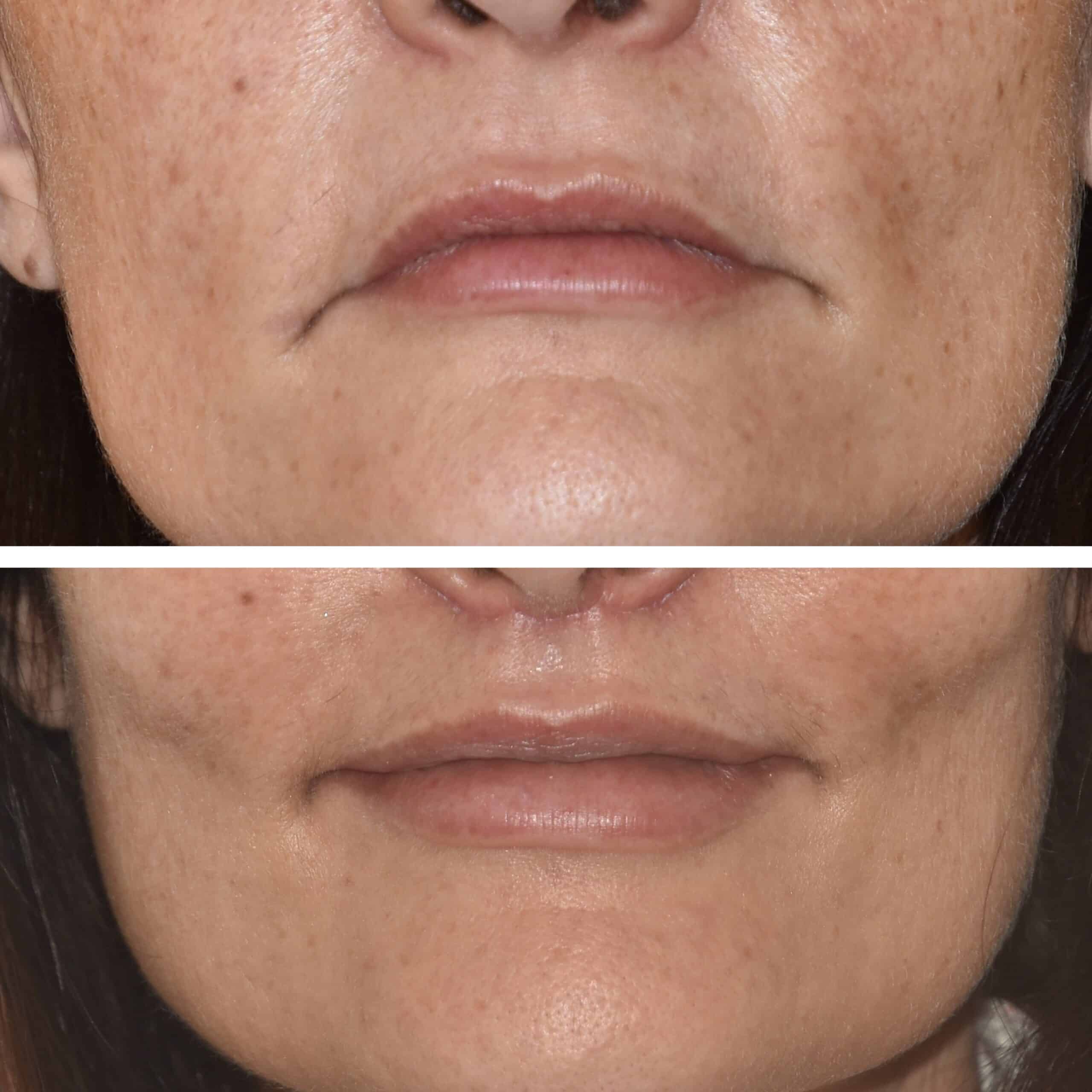 lip lift in calabria