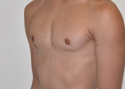 ginecomatia periorelare in calabria